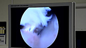 Arthroscopic knee surgery