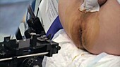 Prostate biopsy surgery