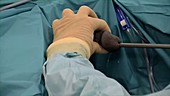 Ureteral lesion biopsy procedure
