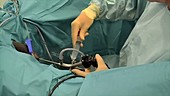 Ureteroscopy procedure