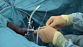 Ureteroscopy procedure