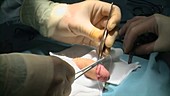 Circumcision surgery