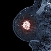 Breast cancer, MRI sequence