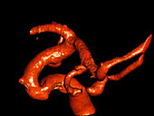 Aneurysm in the brain, 3D angiography