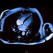 Beating heart, MRI scan