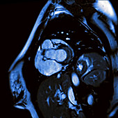 Beating heart, MRI scan