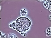 Neutrophils mobbing Trichomonas