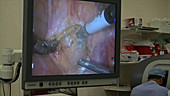 Robotic prostate cancer surgery