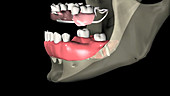 Removable partial denture