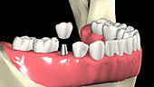 Orthodontic procedure