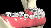 Lower dental braces