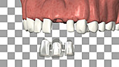 Dental bridge