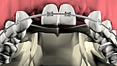 Orthodontic procedure