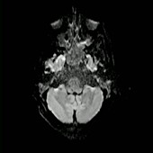 Brain injury, MRI scan sequence