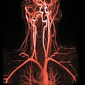 Artery damage, MRA scan sequence