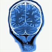 Brain injury, MRI scan sequence