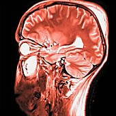 Brain injury, MRI scan sequence