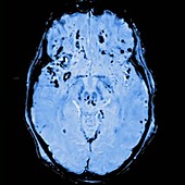 Brain injury, MRI scan sequence