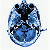 Brain injury, MRI scan sequence