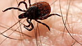 Tick stumbling through human hair