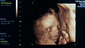 Foetal ultrasound scans