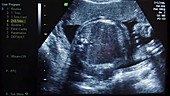 Foetal ultrasound scans