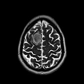 Glioma brain tumour, MRI sequence