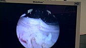 Endoscopic view of TURP procedure