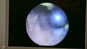 Endoscope footage of a TURP biopsy