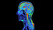 Normal MRI brain scan, sagittal view