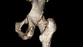 Hip joint arthritis, 3D MRI scan