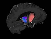 Brain tumour, DTI MRI scan
