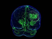 Brain tumour, 3D MRI scan