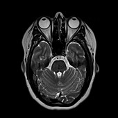Multiple sclerosis, brain MRI sequence