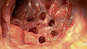 Diverticula in the colon
