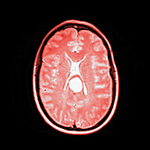 Brain membrane tumour, MRI sequence