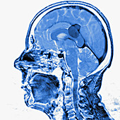 Brain membrane tumour, MRI sequence