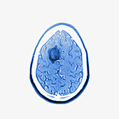 Glioma brain tumour, MRI sequence