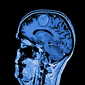 Glioma brain tumour, MRI sequence