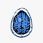 Glioma brain tumour, MRI sequence