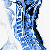 Degenerative cervical spine, MRI sequence