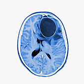 Brain abscess, MRI sequence