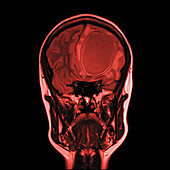 Brain abscess, MRI sequence