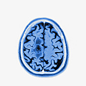Glioma brain tumour, MRI sequence