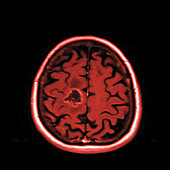 Glioma brain tumour, MRI sequence