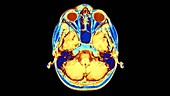 Brain, MRI scans