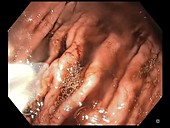 Barrett's oesophagus, endoscope view