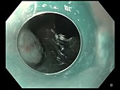 Barrett's oesophagus, endoscope view