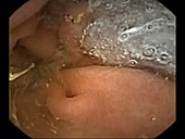 Stomach and duodenum, pill camera footage