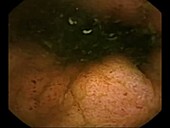 Crohn's disease, pill camera footage